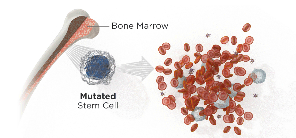 Mutated stem cells in bone marrow