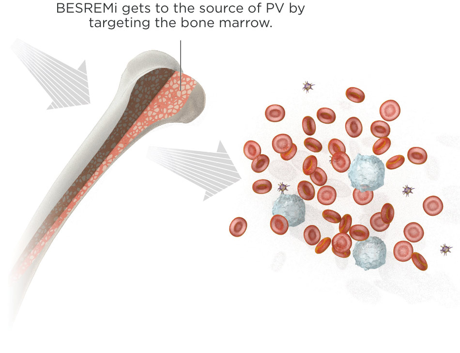BESREMi gets to the source of polycythemia vera by targeting the bone marrow